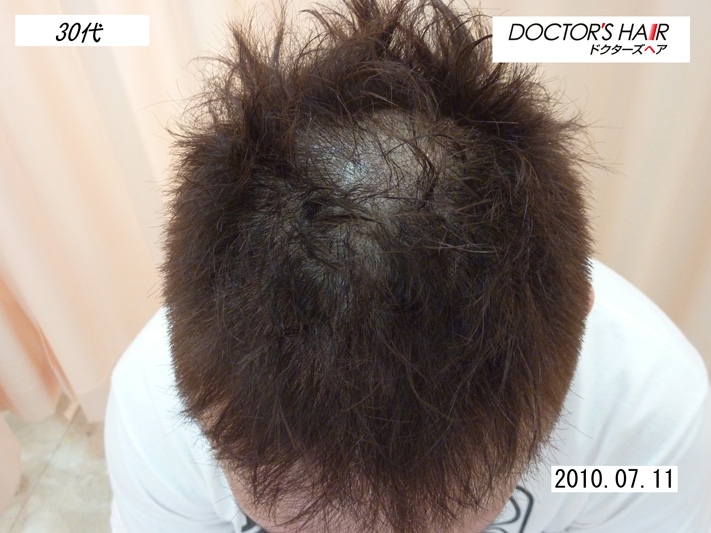 男性型脱毛症 Aga治療は実績と経験のある大阪市のクリニック