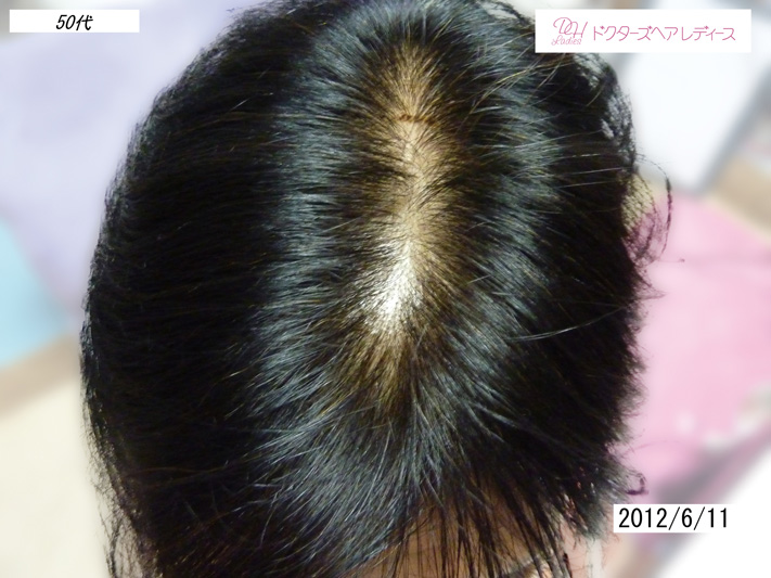 女性の薄毛 Fagaでお悩みの方へ大阪の評判の薄毛治療